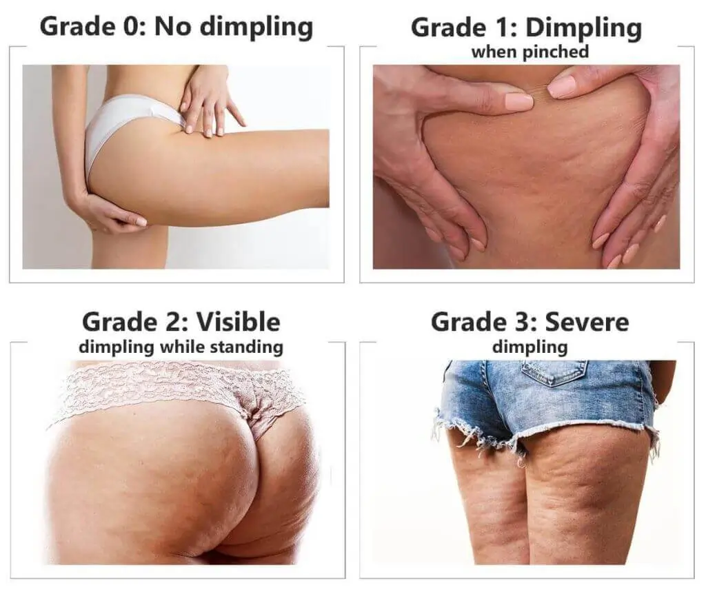 Representation of the stages of cellulite development Southampton